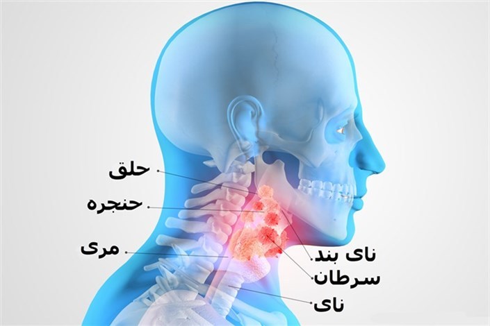 آشنایی با راه‌های پیشگیری و درمان سرطان حنجره