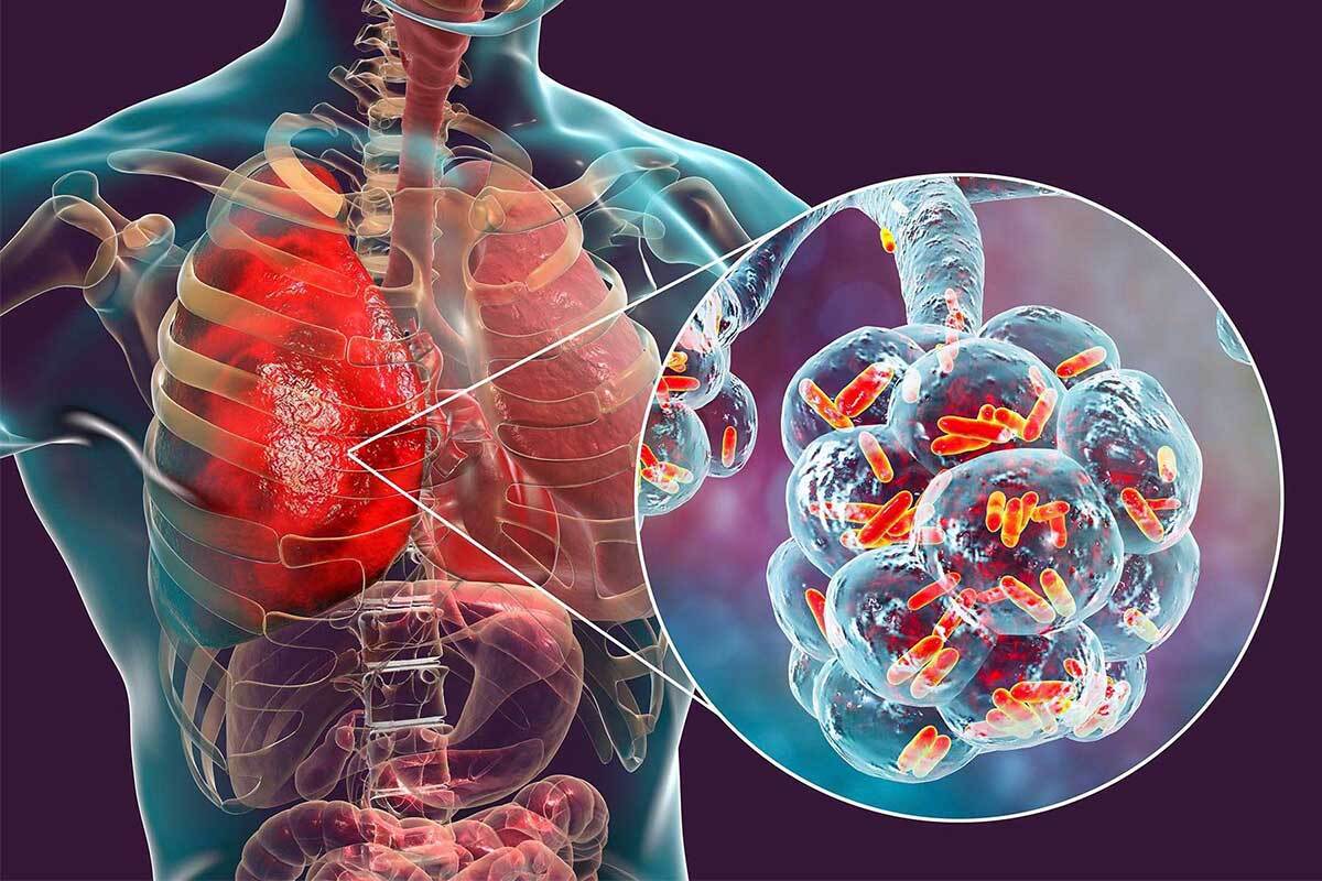 توصیه‌های بهداشتی برای پیشگیری از عفونت‌های حاد تنفسی