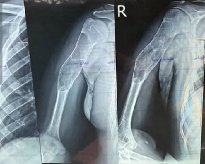 پیوند موفقیت‌آمیز استخوان مصنوعی بازو در پارس‌آباد