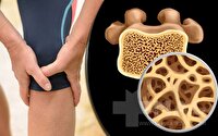 پوکی استخوان؛ بیماری خاموشی که تا شکستگی ادامه دارد